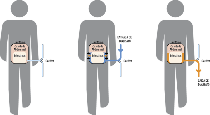 diálise-peritoneal.png